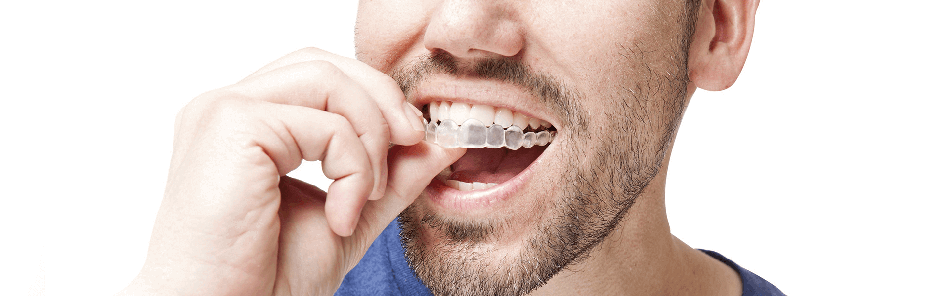 When to Use Invisalign® over Traditional Orthodontics