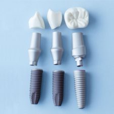 How Long Does It Take to Get Dental Implants?