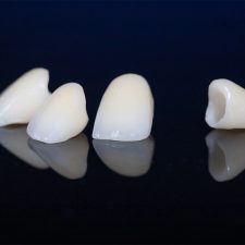How to Care for Your Dental Crown for Long-Term Results