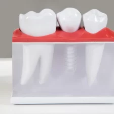 7 Signs You May Need a Dental Implant Before the Problem Gets Worse